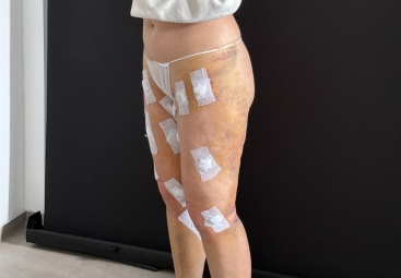 Convalescence après une liposuccion du lipoedème : le témoignage de Sylvie